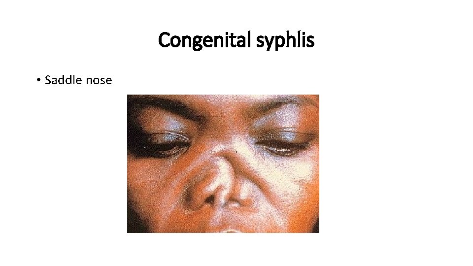 Congenital syphlis • Saddle nose 