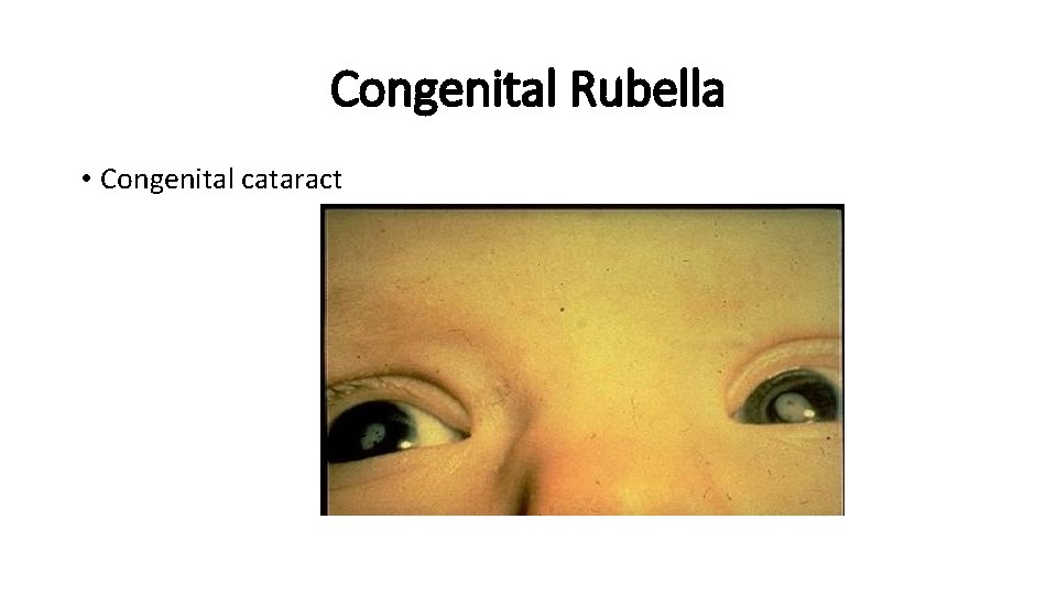 Congenital Rubella • Congenital cataract 