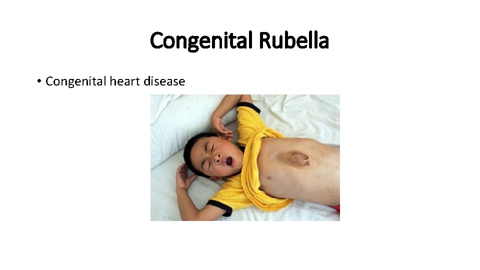 Congenital Rubella • Congenital heart disease 