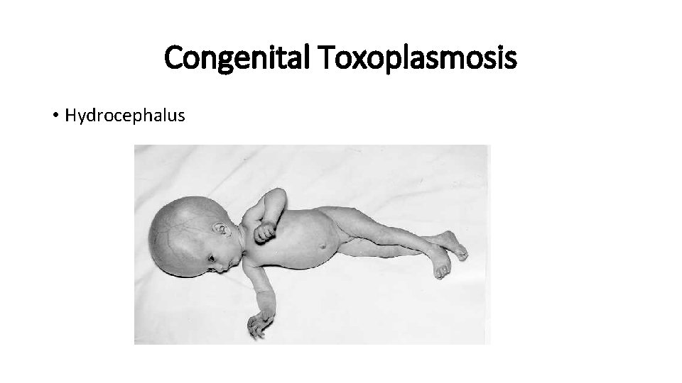Congenital Toxoplasmosis • Hydrocephalus 