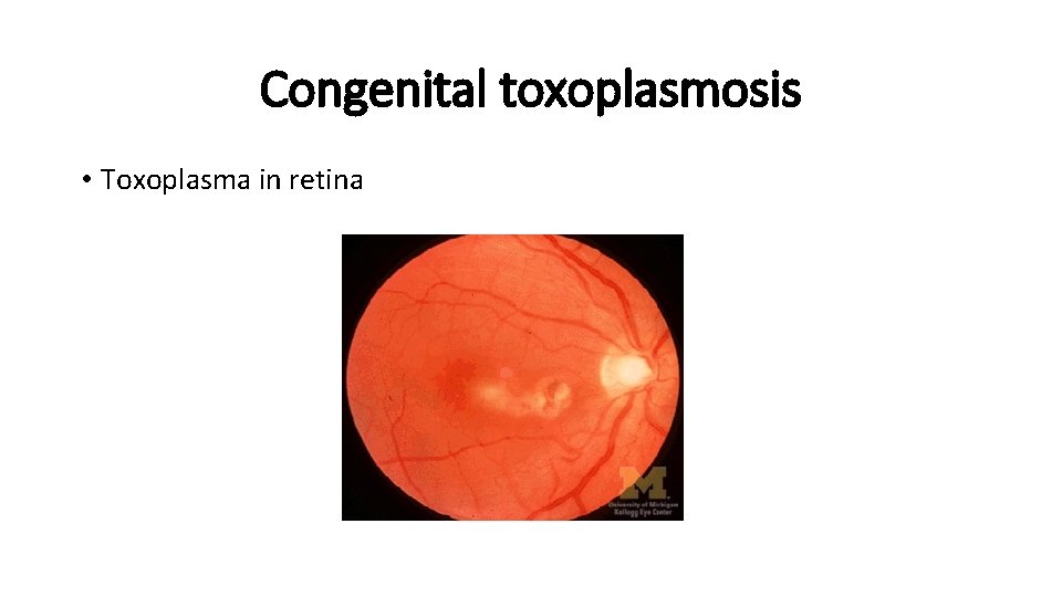 Congenital toxoplasmosis • Toxoplasma in retina 