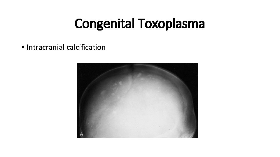 Congenital Toxoplasma • Intracranial calcification 