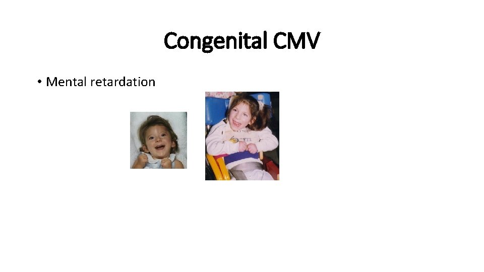 Congenital CMV • Mental retardation 