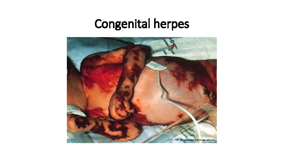 Congenital herpes 