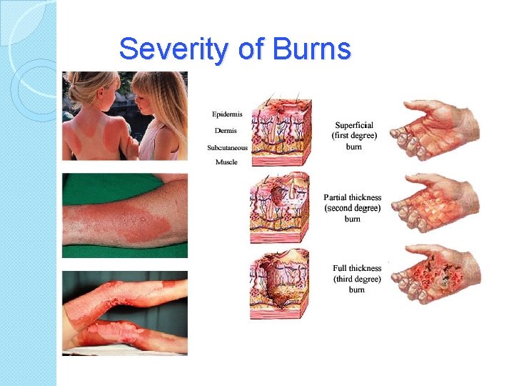 Severity of Burns 