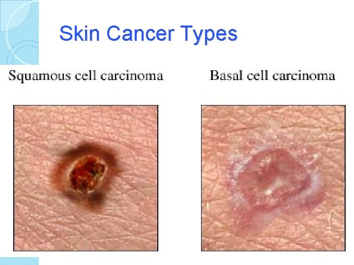 Skin Cancer Types 