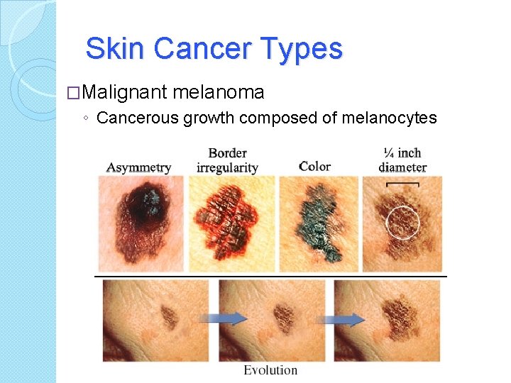 Skin Cancer Types �Malignant melanoma ◦ Cancerous growth composed of melanocytes 