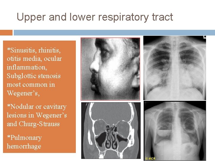Upper and lower respiratory tract *Sinusitis, rhinitis, otitis media, ocular inflammation, Subglottic stenosis most