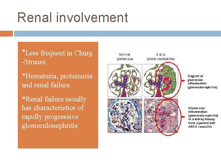 Renal involvement *Less frequent in Churg -Strauss *Hematuria, proteinuria and renal failure *Renal failure
