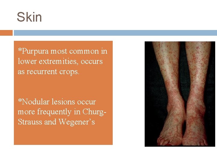 Skin *Purpura most common in lower extremities, occurs as recurrent crops. *Nodular lesions occur
