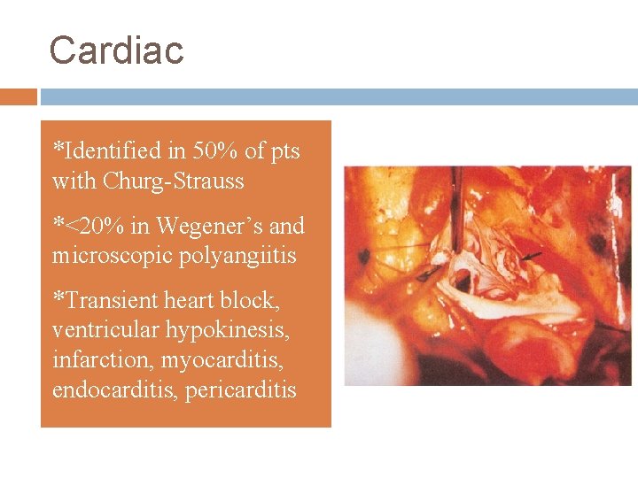 Cardiac *Identified in 50% of pts with Churg-Strauss *<20% in Wegener’s and microscopic polyangiitis
