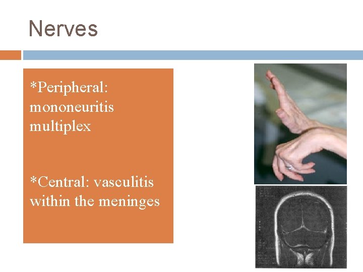 Nerves *Peripheral: mononeuritis multiplex *Central: vasculitis within the meninges 