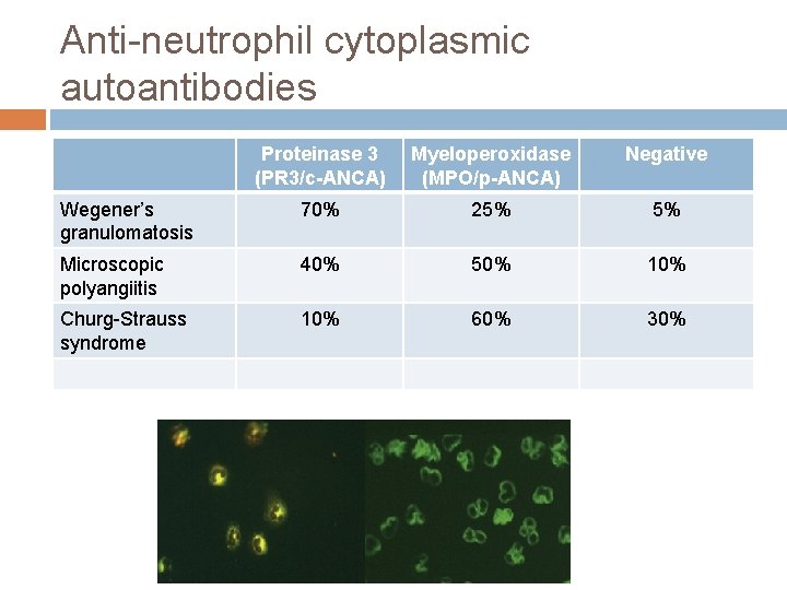 Anti-neutrophil cytoplasmic autoantibodies Proteinase 3 (PR 3/c-ANCA) Myeloperoxidase (MPO/p-ANCA) Negative Wegener’s granulomatosis 70% 25%