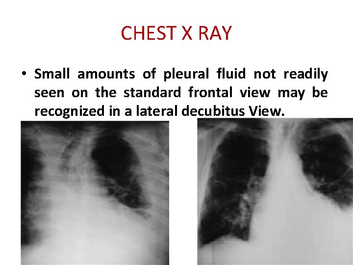 CHEST X RAY • Small amounts of pleural fluid not readily seen on the