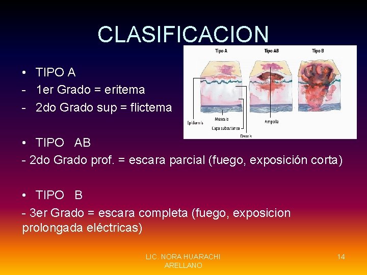 CLASIFICACION • TIPO A - 1 er Grado = eritema - 2 do Grado