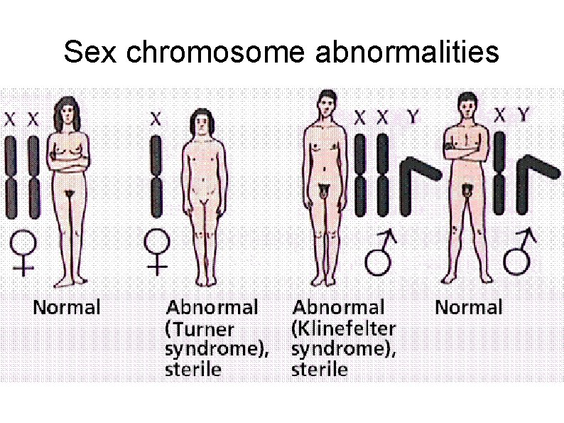 Sex chromosome abnormalities 