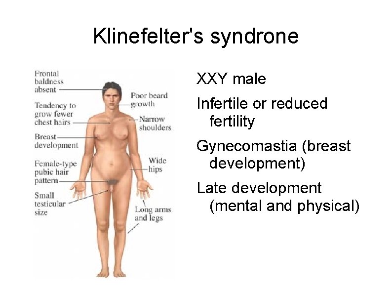 Klinefelter's syndrone XXY male Infertile or reduced fertility Gynecomastia (breast development) Late development (mental