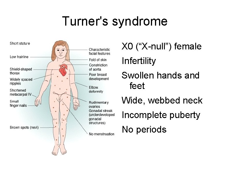 Turner's syndrome X 0 (“X-null”) female Infertility Swollen hands and feet Wide, webbed neck