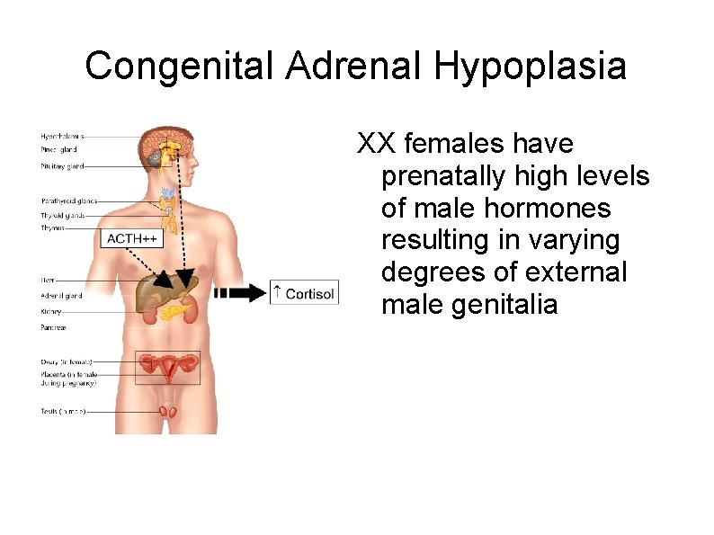 Congenital Adrenal Hypoplasia XX females have prenatally high levels of male hormones resulting in