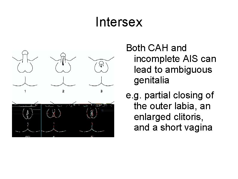 Intersex Both CAH and incomplete AIS can lead to ambiguous genitalia e. g. partial