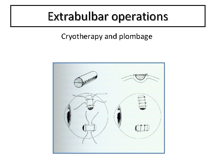 Extrabulbar operations Cryotherapy and plombage 