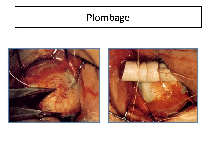 Plombage 