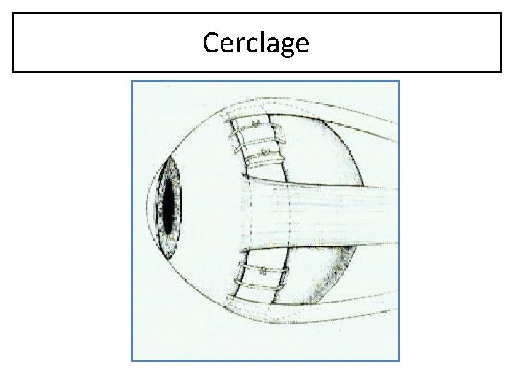 Cerclage 