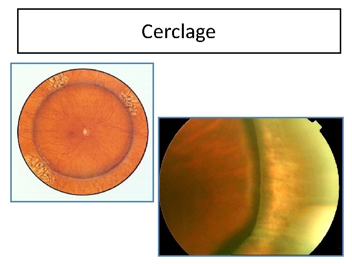 Cerclage 