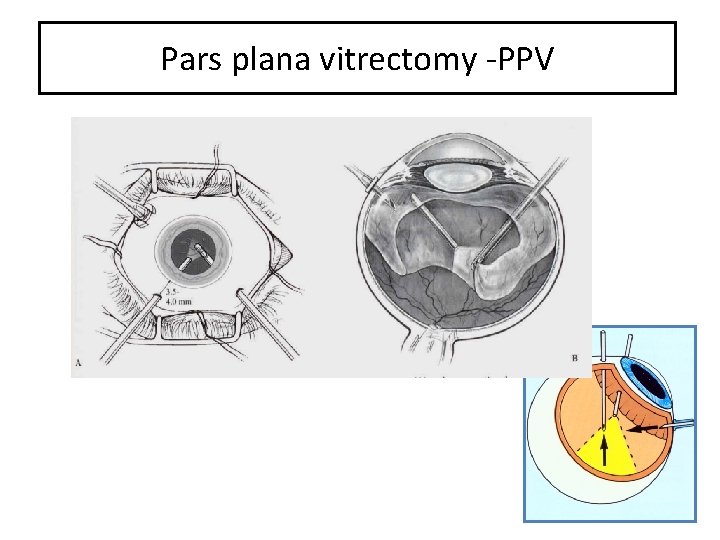 Pars plana vitrectomy -PPV 