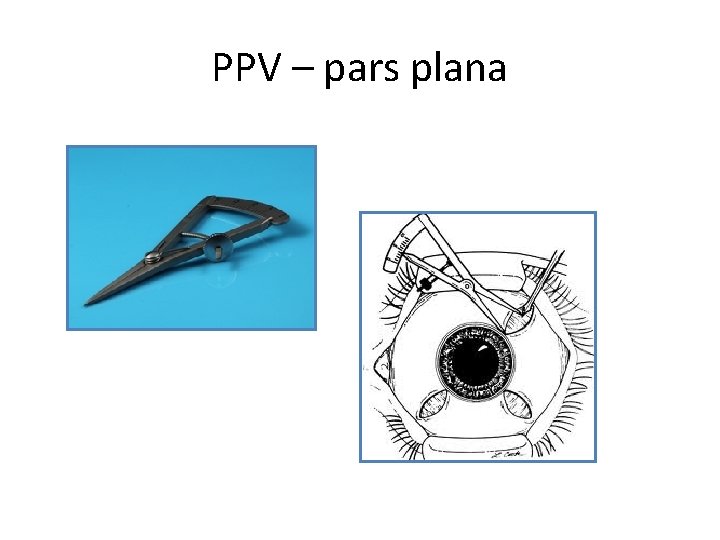 PPV – pars plana 