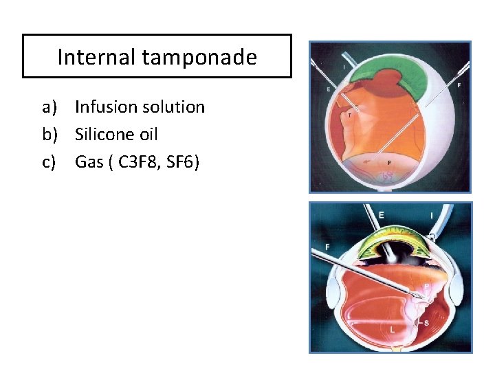 Internal tamponade a) Infusion solution b) Silicone oil c) Gas ( C 3 F