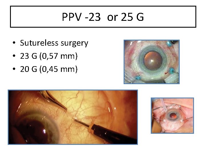 PPV -23 or 25 G • Sutureless surgery • 23 G (0, 57 mm)