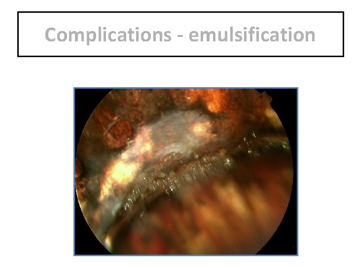 Complications - emulsification 