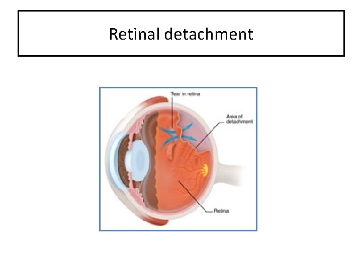 Retinal detachment 