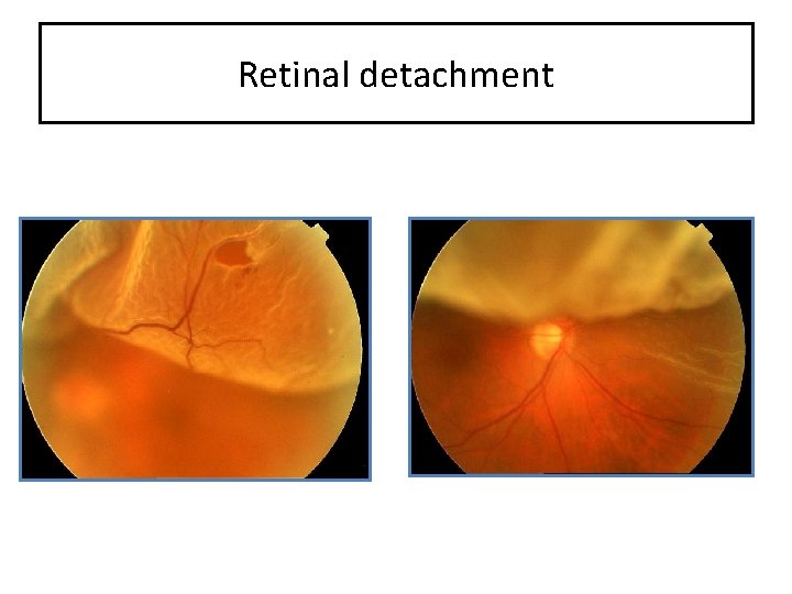 Retinal detachment 