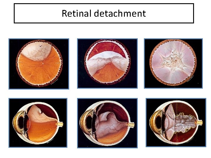 Retinal detachment 