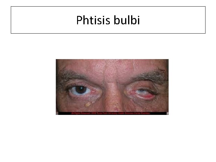 Phtisis bulbi 