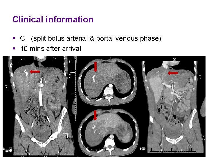 Clinical information § CT (split bolus arterial & portal venous phase) § 10 mins