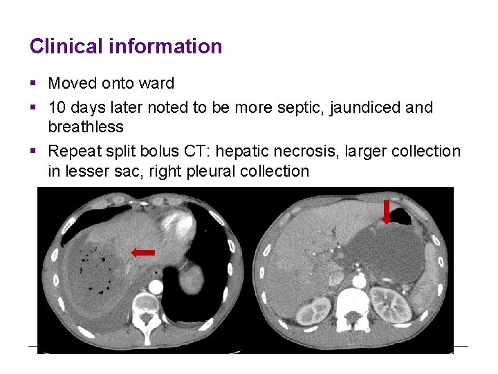 Clinical information § Moved onto ward § 10 days later noted to be more