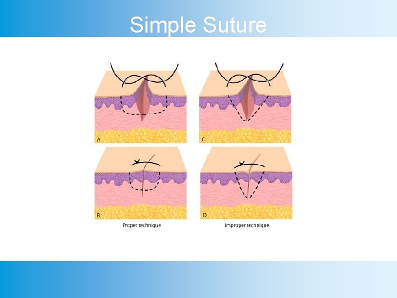 Simple Suture 
