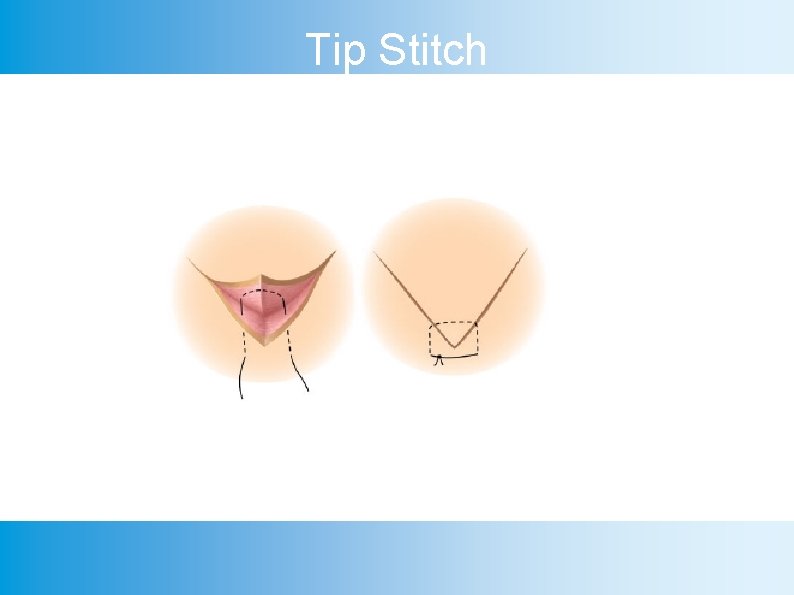 Tip Stitch 