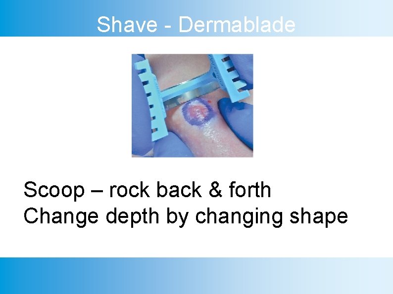 Shave - Dermablade Scoop – rock back & forth Change depth by changing shape