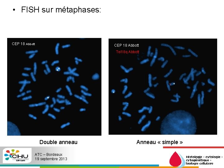  • FISH sur métaphases: CEP 18 Abbott Tel 18 q Abbott Double anneau