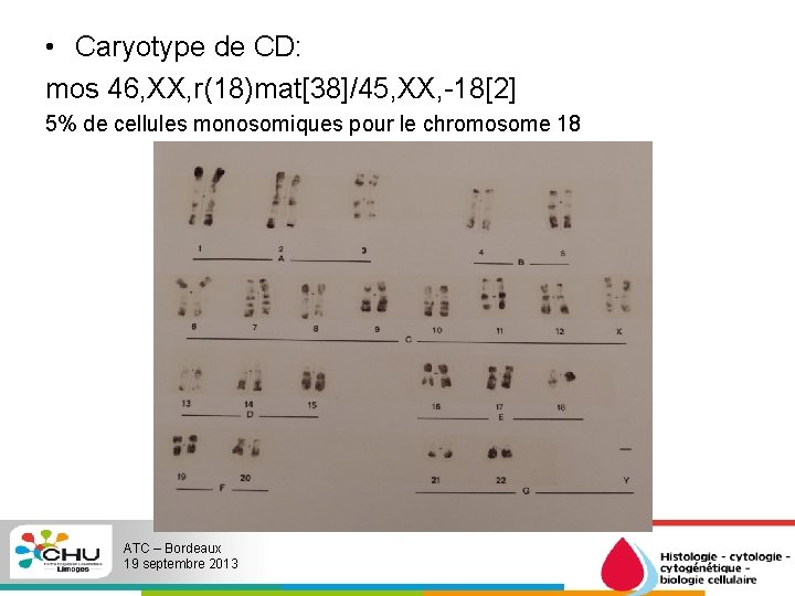  • Caryotype de CD: mos 46, XX, r(18)mat[38]/45, XX, -18[2] 5% de cellules