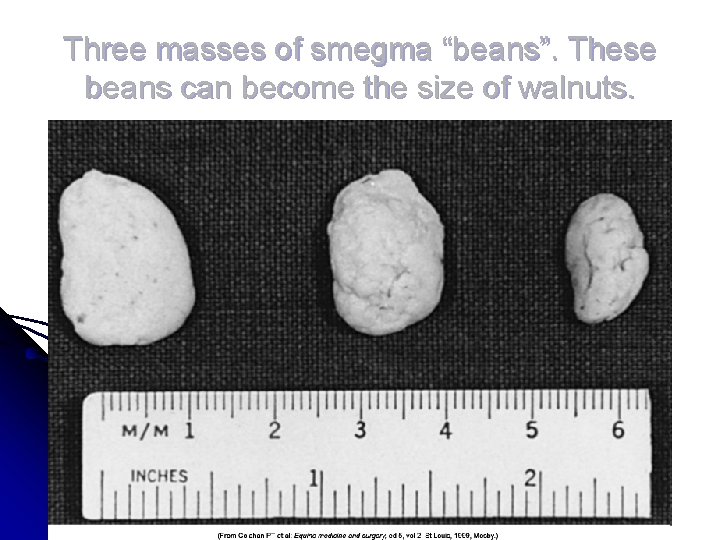 Three masses of smegma “beans”. These beans can become the size of walnuts. 