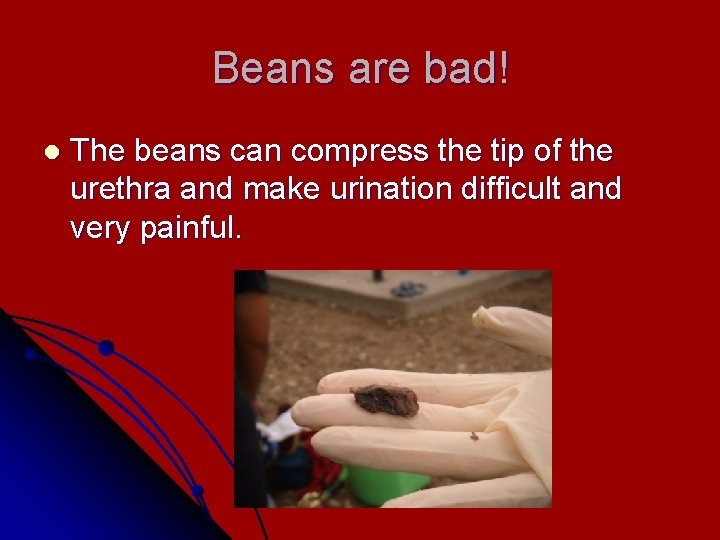 Beans are bad! l The beans can compress the tip of the urethra and