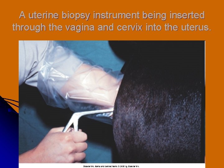 A uterine biopsy instrument being inserted through the vagina and cervix into the uterus.