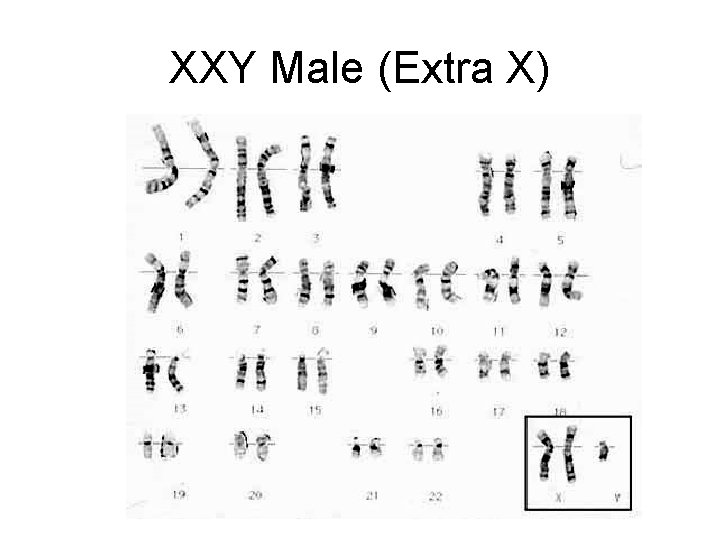 XXY Male (Extra X) XXY Male (Extra X)