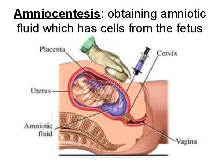 Amniocentesis: obtaining amniotic fluid which has cells from the fetus Amniocentesis: obtaining amniotic fluid which has cells from the fetus