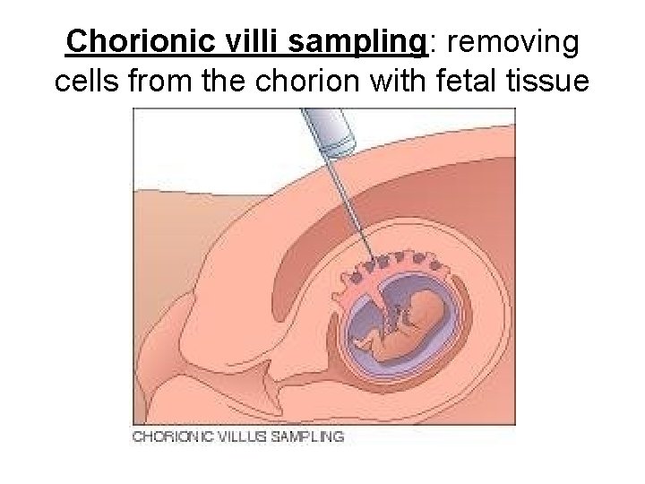 Chorionic villi sampling: removing cells from the chorion with fetal tissue Chorionic villi sampling: removing cells from the chorion with fetal tissue